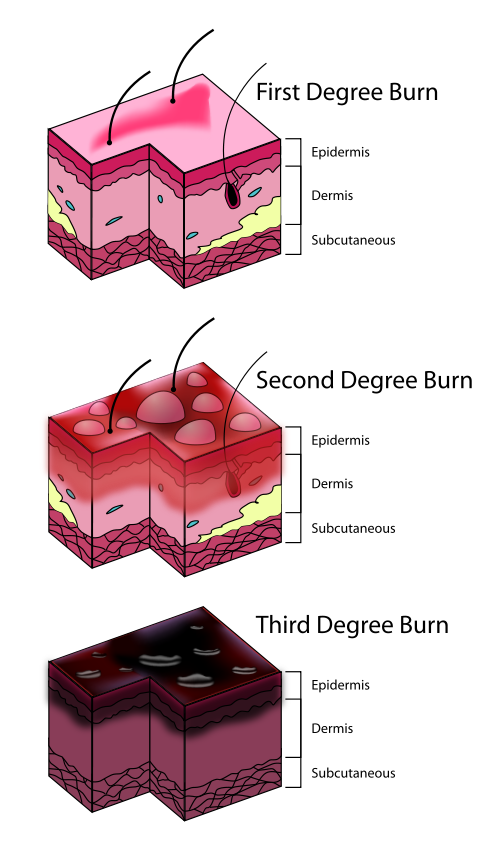 Levels of sunburns diagram