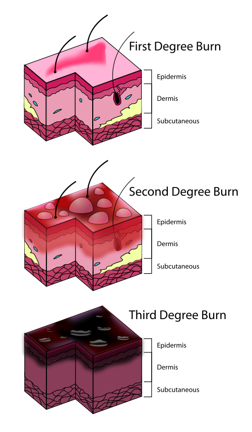 Levels of sunburns