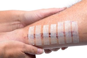Bandages on wound
