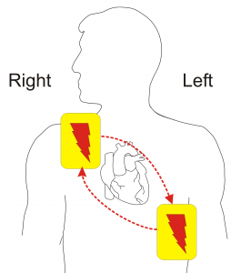 Fibrillation diagram