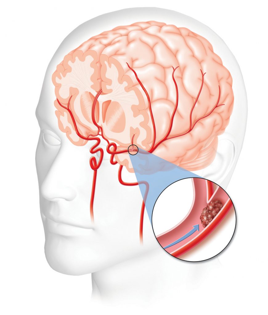 Stroke diagram